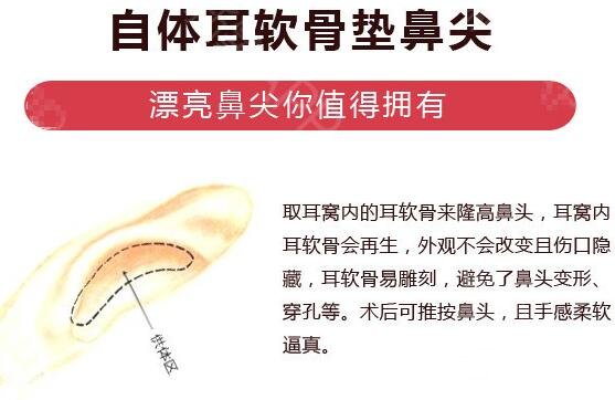上海自體耳軟骨隆鼻價格多少錢？