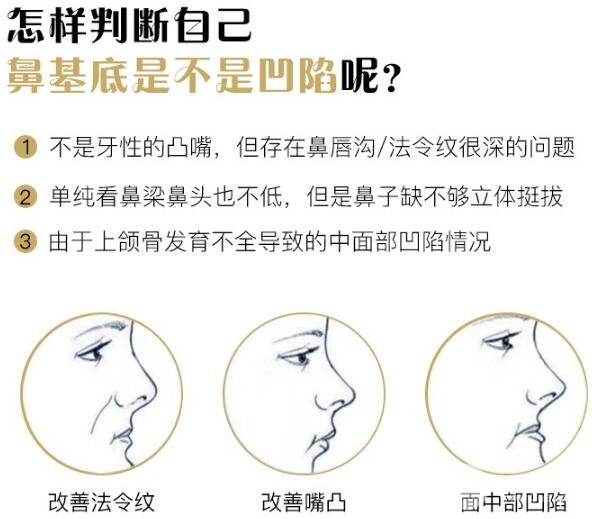 假體墊鼻基底多少錢？貴不貴