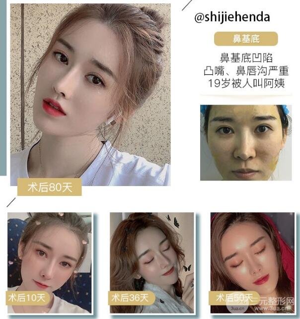 假體墊鼻基底多少錢 果好不好