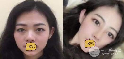 硅膠隆鼻手術(shù)案例