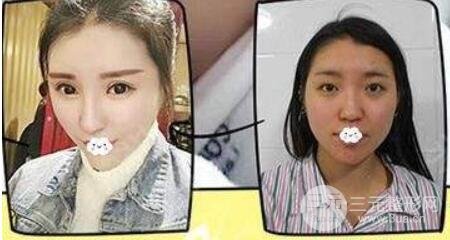 硅膠隆鼻手術(shù)案例