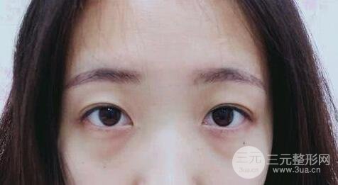 外切去眼袋手術(shù)果，會留疤嗎？