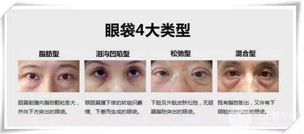 什么是眼袋?