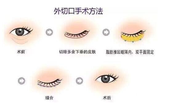 外切去眼袋手術(shù)果怎么樣?