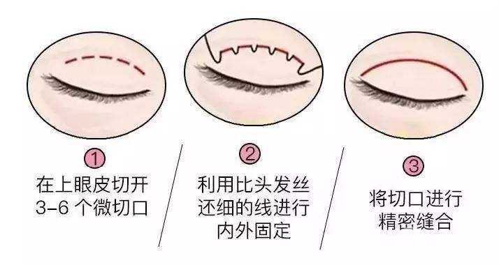 定點雙眼皮手術原理