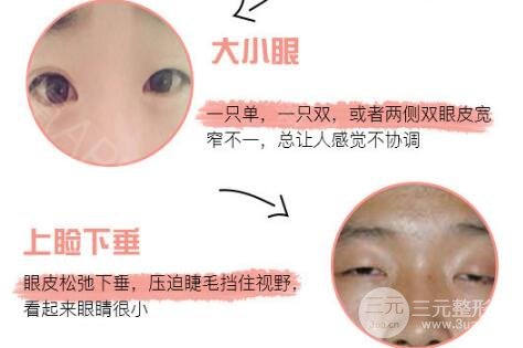 定點雙眼皮價格貴嗎 多少錢