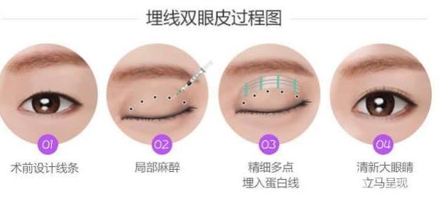 埋線雙眼皮的費用
