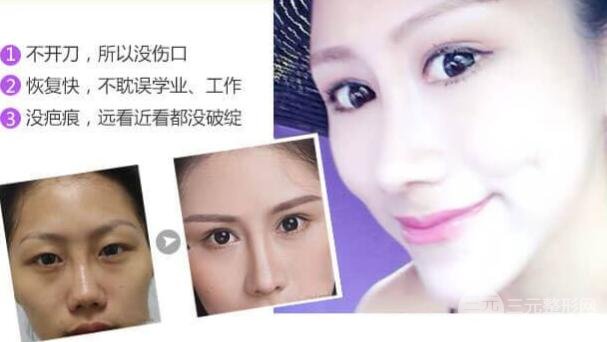 埋線雙眼皮能維持幾年?