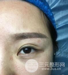 埋線雙眼皮后的注意事項