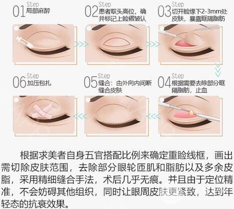 切開雙眼皮手術(shù)原理簡介