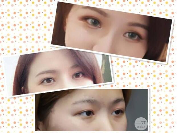 切開雙眼皮多久可以恢復自然微創(chuàng) 案例圖