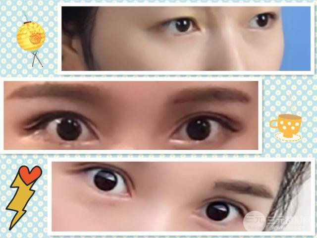 切開雙眼皮多久可以恢復自然