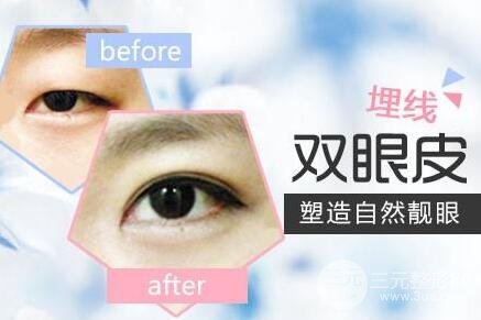 埋線雙眼皮多久恢復(fù)自然?