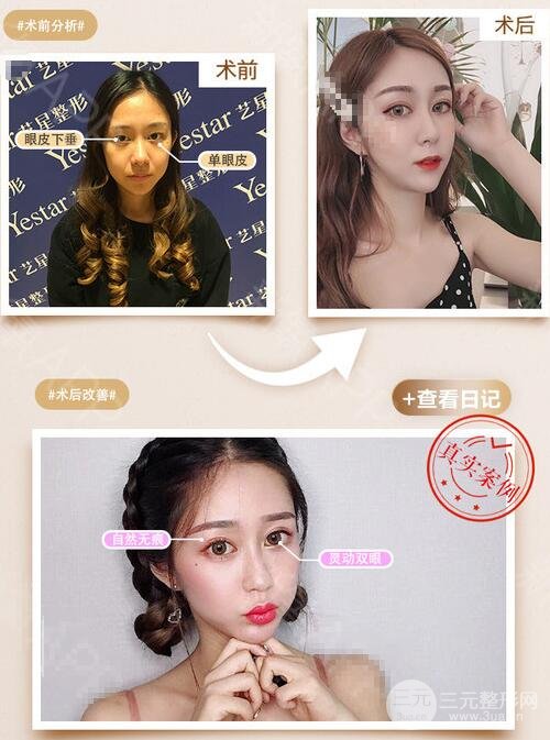 切開(kāi)雙眼皮案例圖