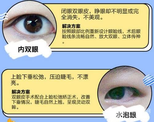 切開(kāi)雙眼皮適合哪些人