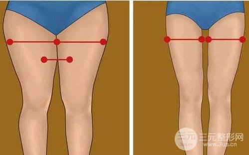 吸脂瘦大腿腫脹期是多久？多久能看到果？