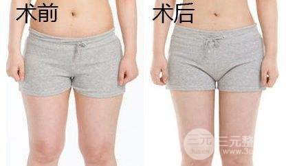 吸脂瘦大腿腫脹期是多久？多久能看到果？