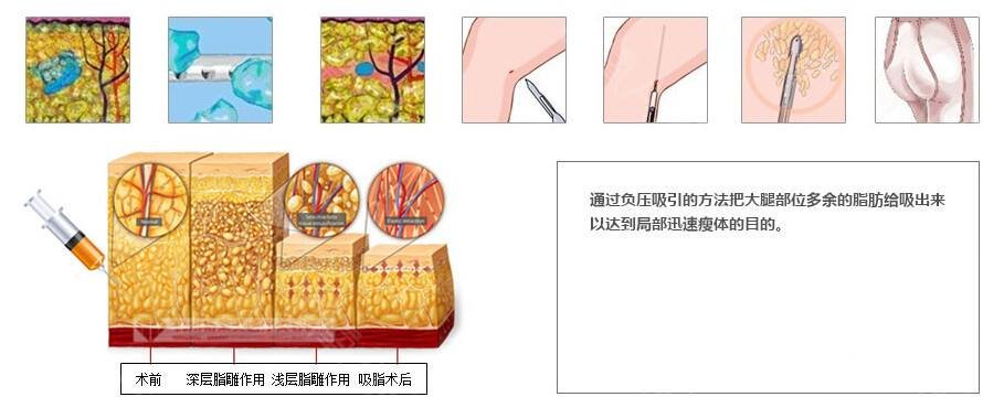 吸脂瘦大腿腫脹期是多久？多久能看到果？