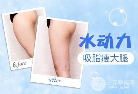 吸脂瘦大腿腫脹期是多久？多久能看到果？