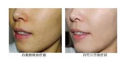 白瓷娃娃美容多少錢？ 原來受這些因素影響~