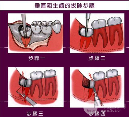 華西口腔醫(yī)院拔牙多少錢