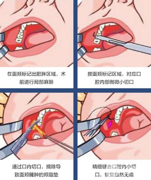 去頰脂墊手術如何操作?