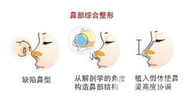 鼻部綜合整形價(jià)格多少錢 主要受3點(diǎn)因素影響~