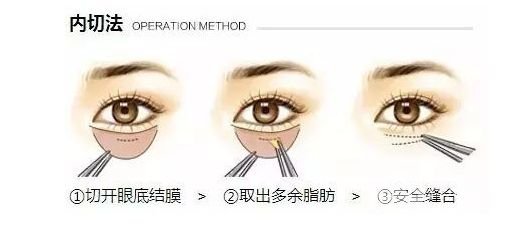 內(nèi)切祛眼袋后遺癥有哪些？幾天消腫？