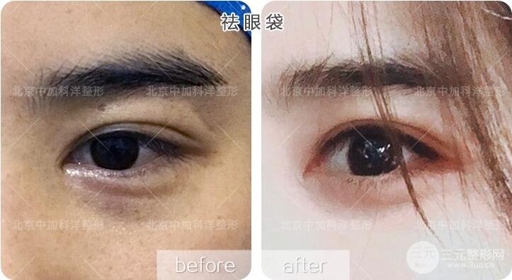 內(nèi)切祛眼袋果圖