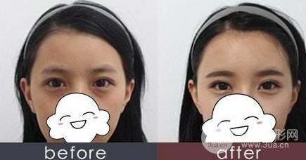 玻尿酸填淚溝會有依賴性嗎？術(shù)后護(hù)理需謹(jǐn)記~