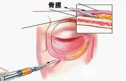 玻尿酸填淚溝會有依賴性嗎？術(shù)后護(hù)理需謹(jǐn)記~