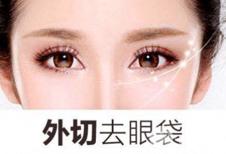 外切去眼袋多久恢復(fù)自然？看完你就懂了~