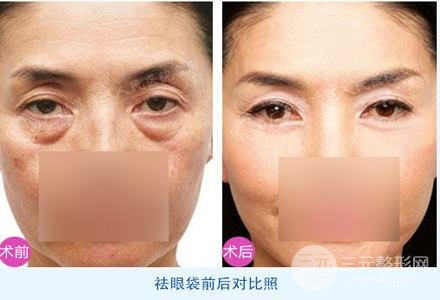 外切去眼袋多久恢復(fù)自然？看完你就懂了~