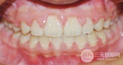 牙齒矯正必須拔牙嗎