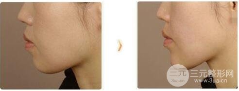 下巴打玻尿酸大概需要多少量？不多，只需要這點(diǎn)！