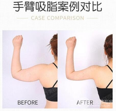 手臂抽脂多久恢復消腫？別著急，先做好這些事！