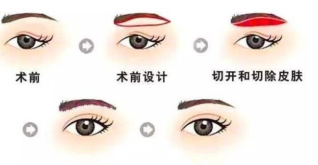 提眉術(shù)