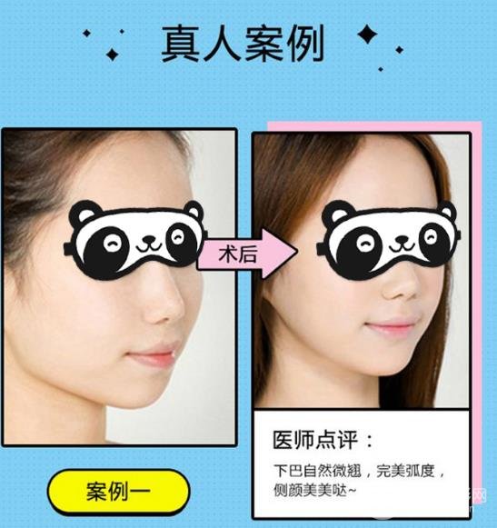 墊下巴手術(shù)后的注意事項(xiàng)