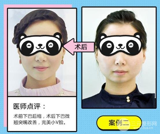 墊下巴手術(shù)后的注意事項(xiàng)