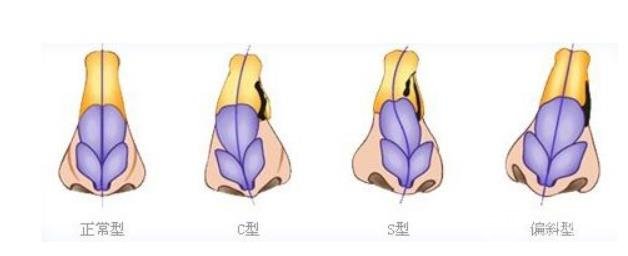 做取隆鼻假體修復(fù)術(shù)的補救措施，如何再次擁有美鼻