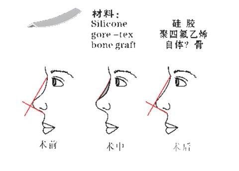 北京硅膠隆鼻手術(shù)價(jià)格