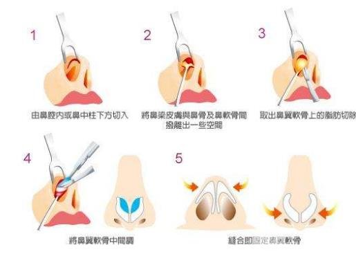 鼻頭縮小手術(shù)價格