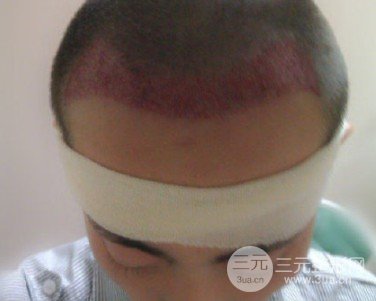 ?？谌嗣襻t(yī)院可以植發(fā)嗎