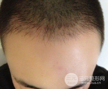 ?？谌嗣襻t(yī)院可以植發(fā)嗎