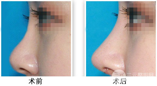 假體隆鼻注意事項(xiàng)有哪些呢？趕緊來科普一下吧~