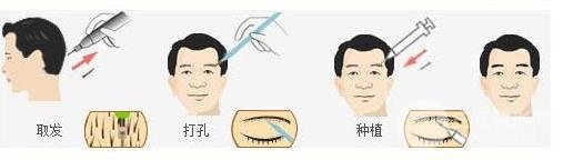 種植眉毛多少錢?