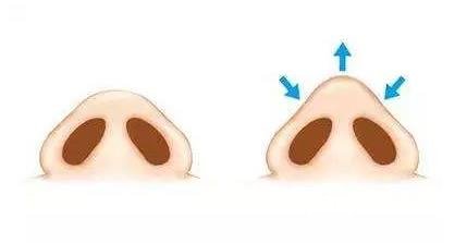 鼻頭縮小術(shù)需要多少錢？
