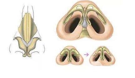 鼻頭縮小術(shù)需要多少錢？