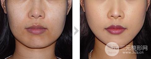 面部吸脂整形多久恢復(fù)自然？科普一下吧~