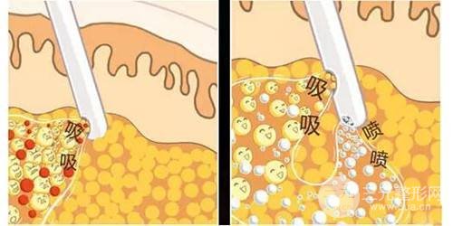 面部吸脂整形多久恢復(fù)自然？科普一下吧~